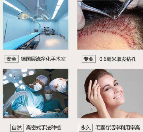 苏州名仕医院植发科价格表