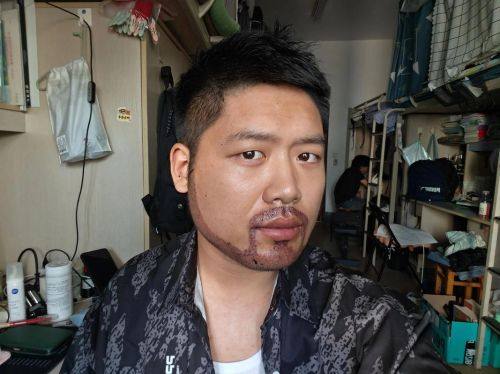 泉州碧莲盛植发医院怎么样？