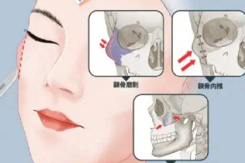 五、特殊情况：术后仍存在肿眼泡怎么办？