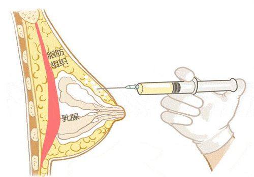 二、正规注射下的副作用:仅存暂时性轻微反应