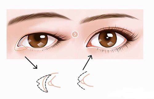 三、腰腹吸脂可能引发的皮肤与外观问题