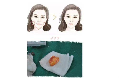 胸大肌后间隙:平胸求美者的理想之选