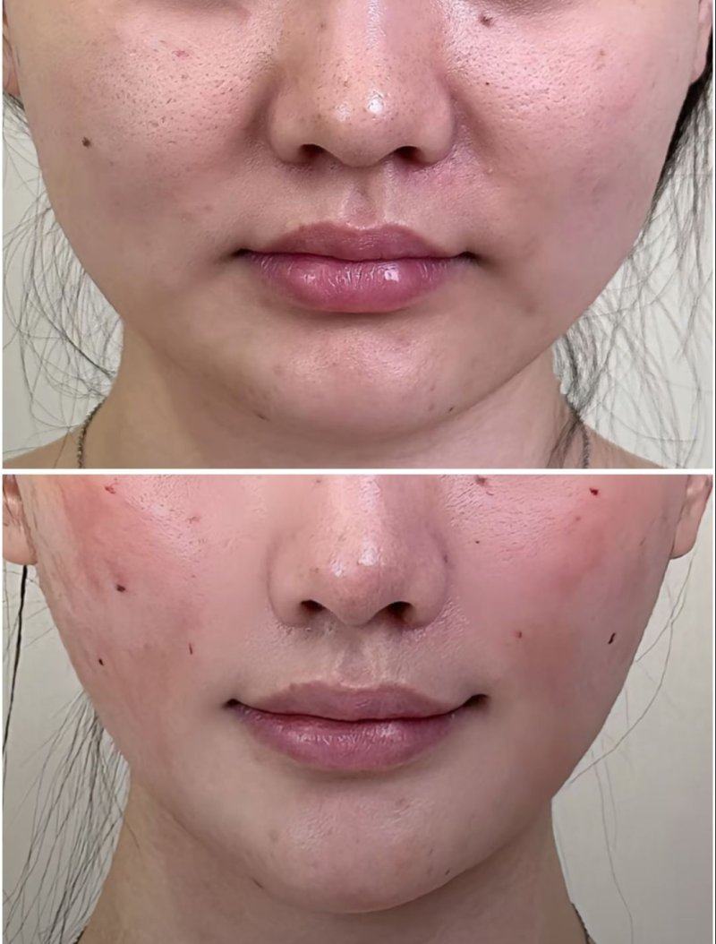 三、医美非手术:轻中度眼周问题的效率高选择