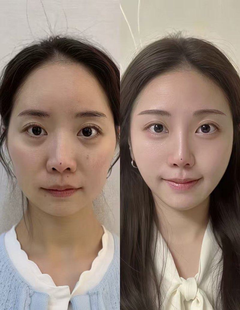 三、面部吸脂几年后可能出现的后遗症有哪些