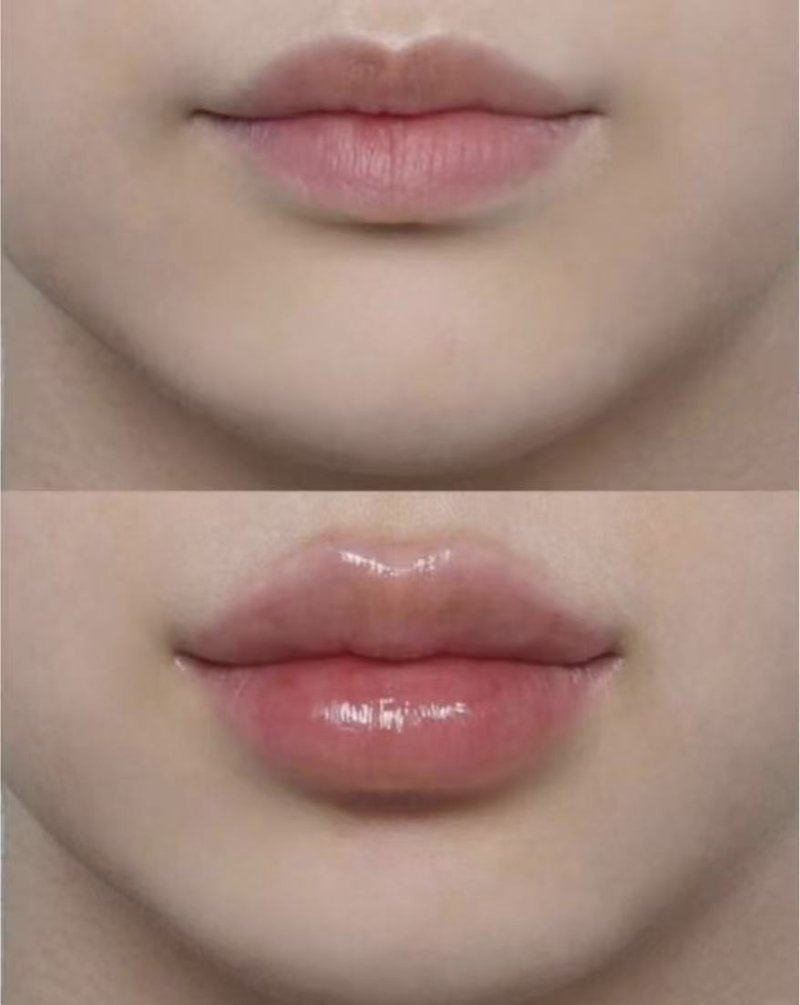 五、15岁可以做隆鼻手术吗?先做好这几步准备