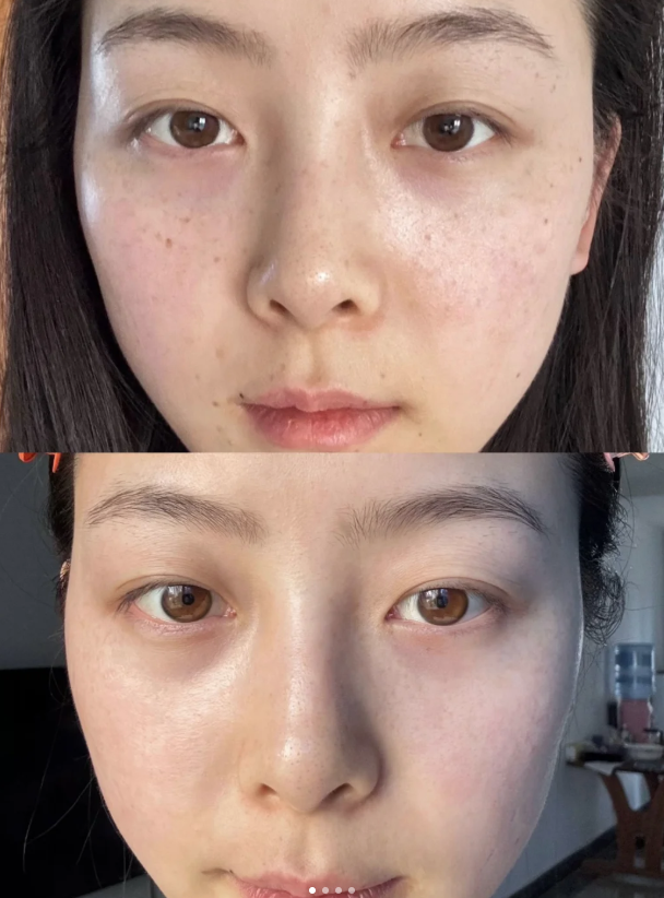 五、脸部抽脂修复的其他关键护理要点