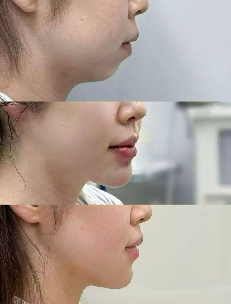 闫爱跃医生:胸大肌下放置+五维技术打造自然胸型