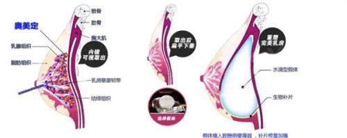 圆眼睛适合做哪种双眼皮？不开眼角该怎么选？