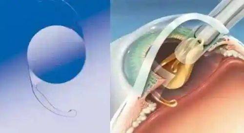 二、面诊排期:灵活调整,更快2天即可手术