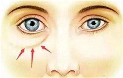 三、医美手段介入：解决中度以上顽固眼袋细纹