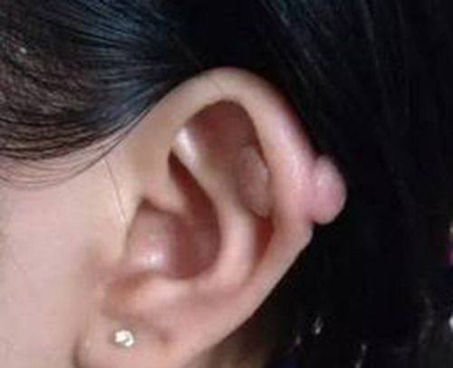 二、疤痕增生手术住院时长与修复周期