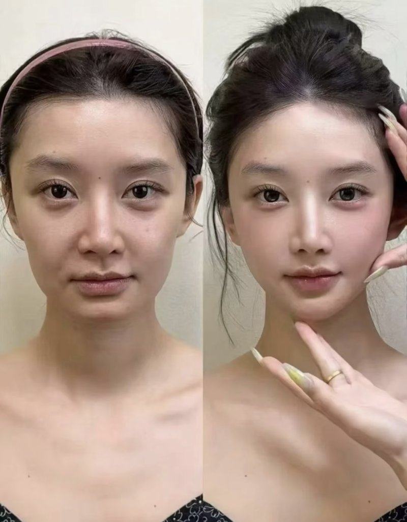 四、特殊情况应对：内切眼袋术后出现细纹的改善方法