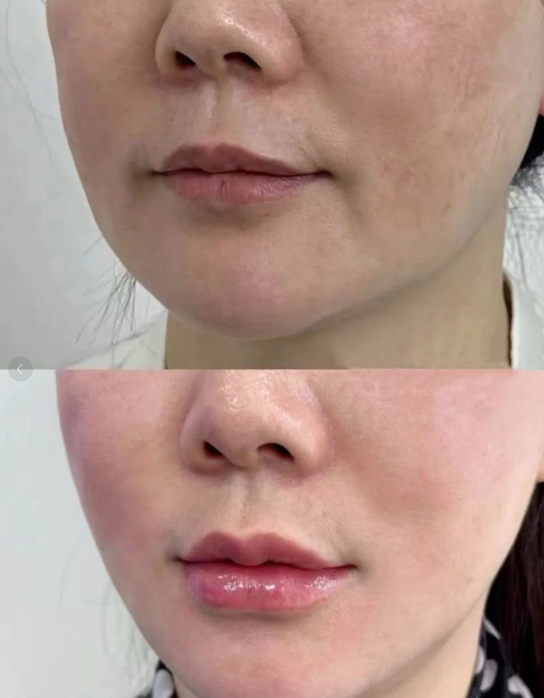 二、耳软骨隆鼻鼻尖的吸收率范围及对成效的影响