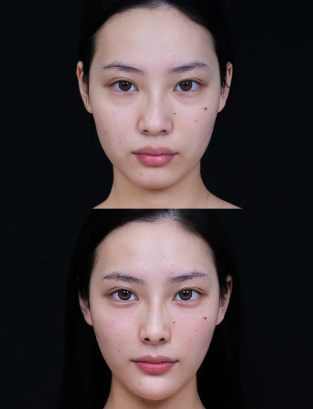 四、关于耳软骨隆鼻鼻尖吸收的常见疑问解答