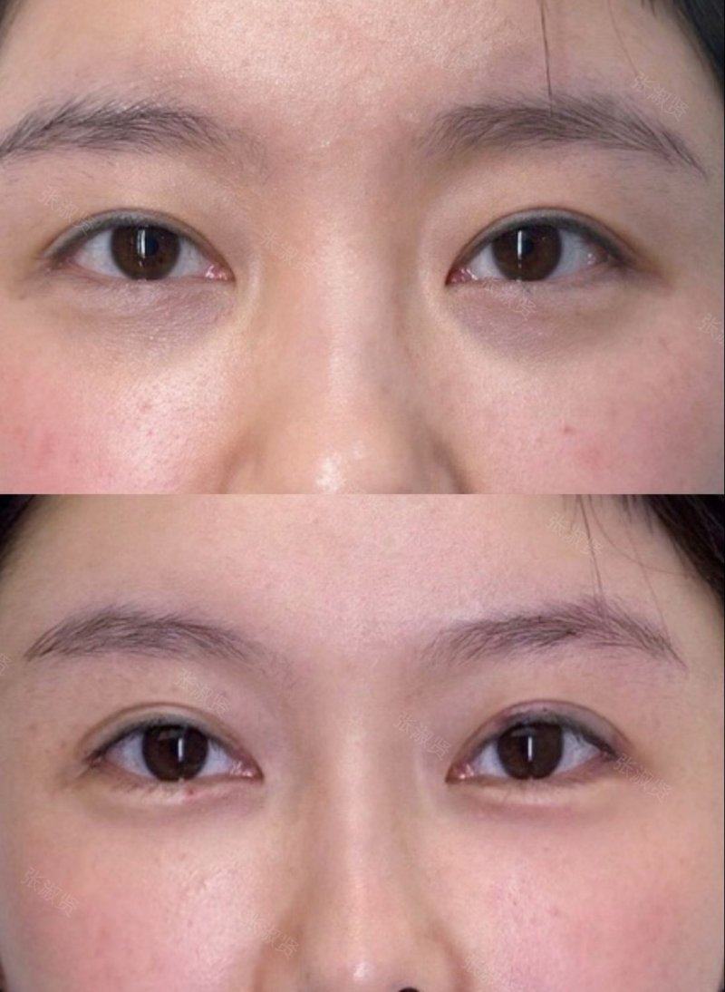 四、伤口缝合后疤痕用什么能去掉?实用修复工具与药物