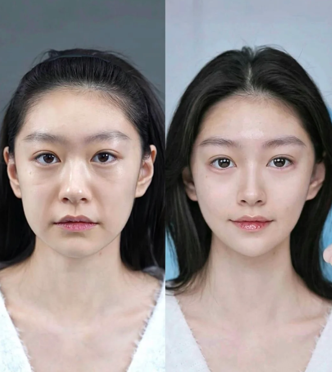 圆眼睛适合做双眼皮吗？做出来好看吗？