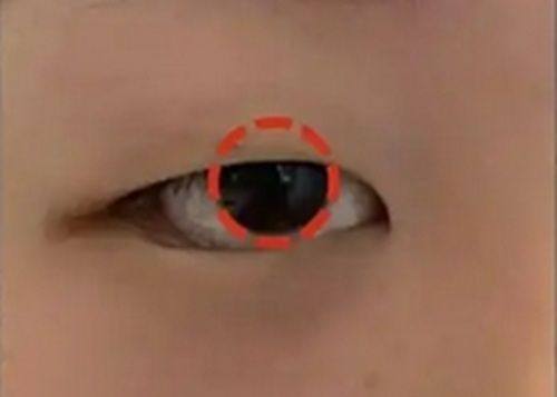 二、不同吸脂技术的“不反弹”验证