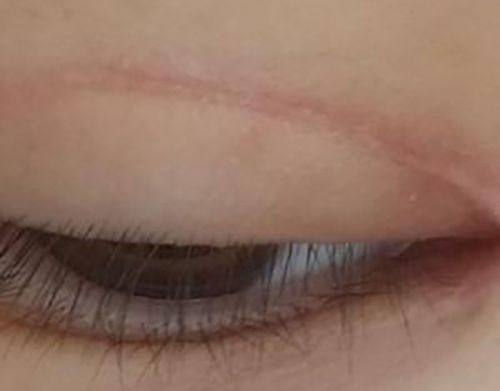 四、感染与眼部刺激的术后护理关联问题