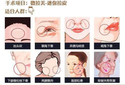 四、双眼皮二次修复的关键注意事项