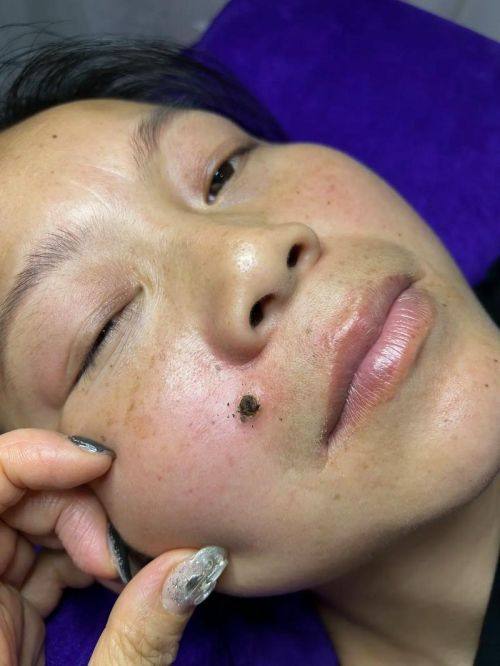 石家庄新兴中医皮肤病医院中医美容科擅长项目：