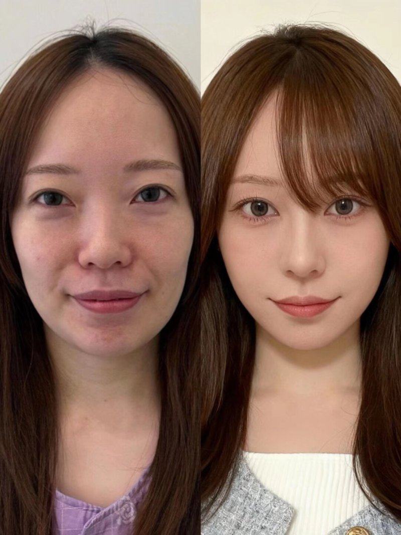 二、2025年割双眼皮手术价格参考