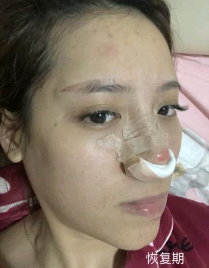 五、广东韩妃医疗美容医院：术后蜕变的真实感受