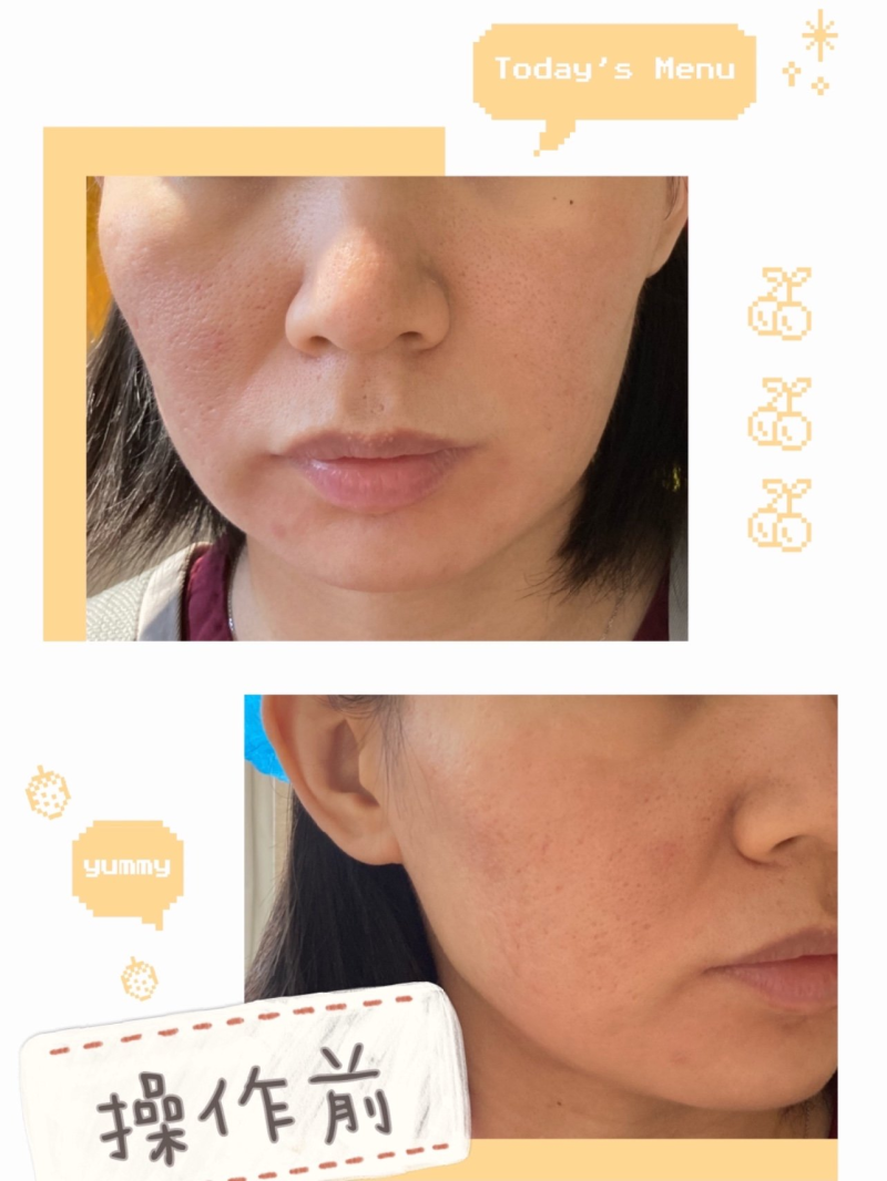 30岁中下面部松弛下垂，广东韩妃蒋水清做半岛超声炮，淡法令纹紧下颌线