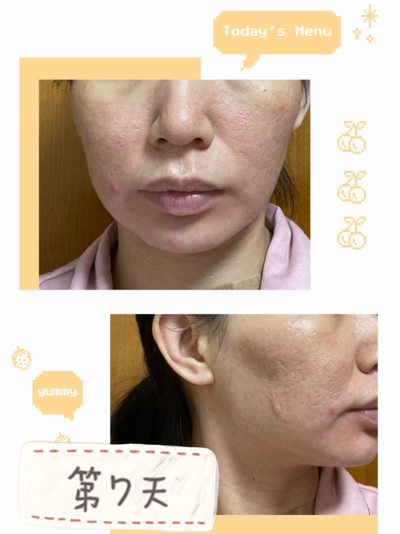 三、广东韩妃半岛超声炮：解锁午餐式抗衰黑科技