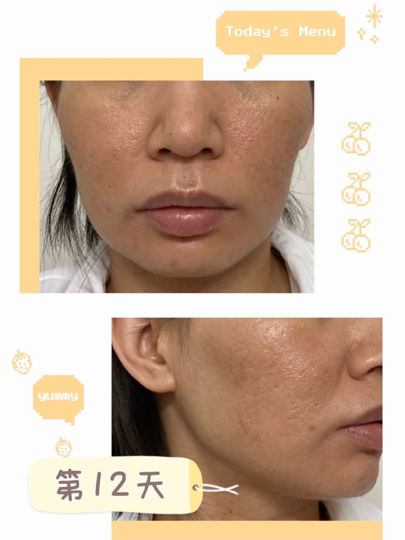 四、广东韩妃半岛超声炮：12天真实成效全记录