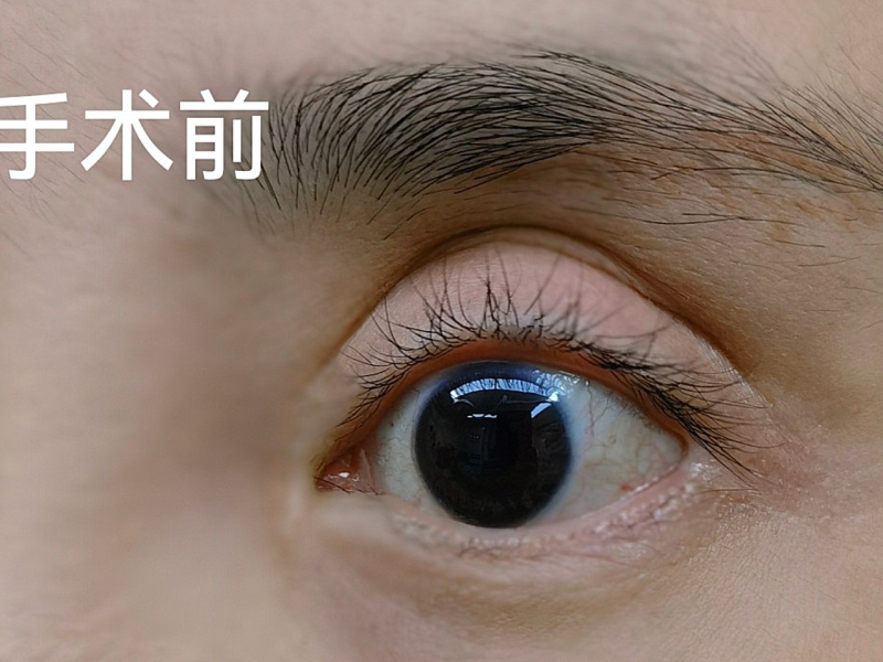 两次双眼皮手术失败陷绝望，赵翊利教授修复眼型、填平凹眼窝还处理眼角赘肉，重获自信