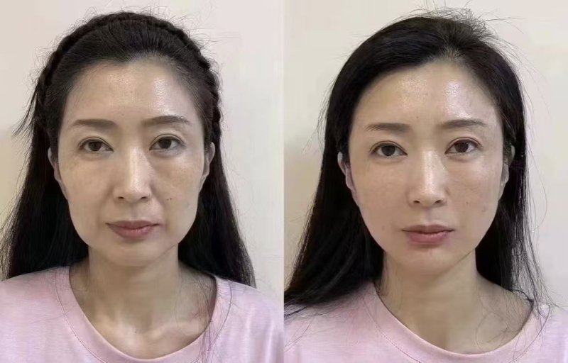 三、医美光电辅助：非侵入式改善疤痕