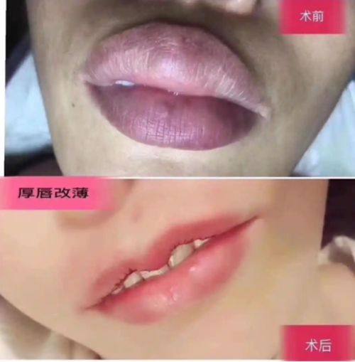 二、这些眼部情况，建议双眼皮联合开眼角