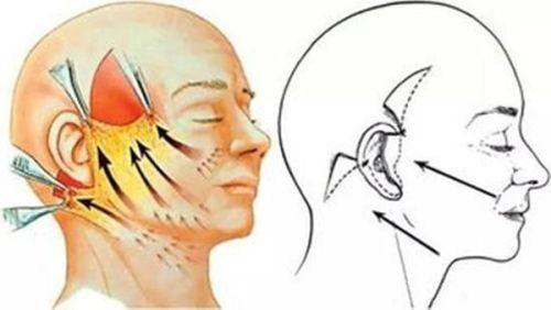 三、不同吸脂技术的修复与见效差异对比