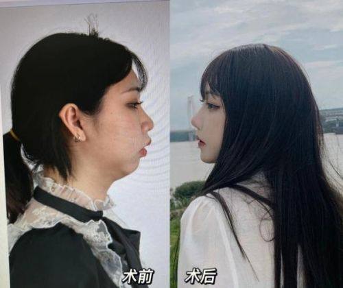 二、手术类除皱项目：长效抗衰，维持5-15年不等