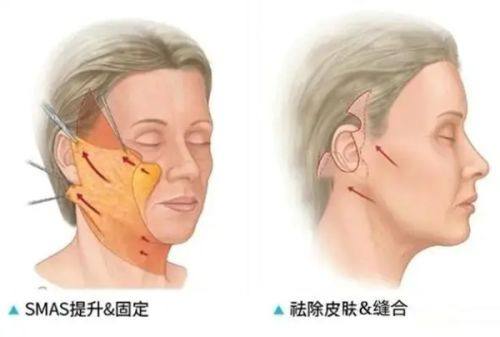 四、割完双眼皮可以吃芝士片吗