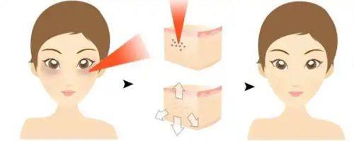 三、日常护理中的祛红印小妙招