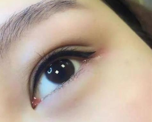 三、术后一段时间（数月至数年）：视情况抽线，尽早操作减少粘连