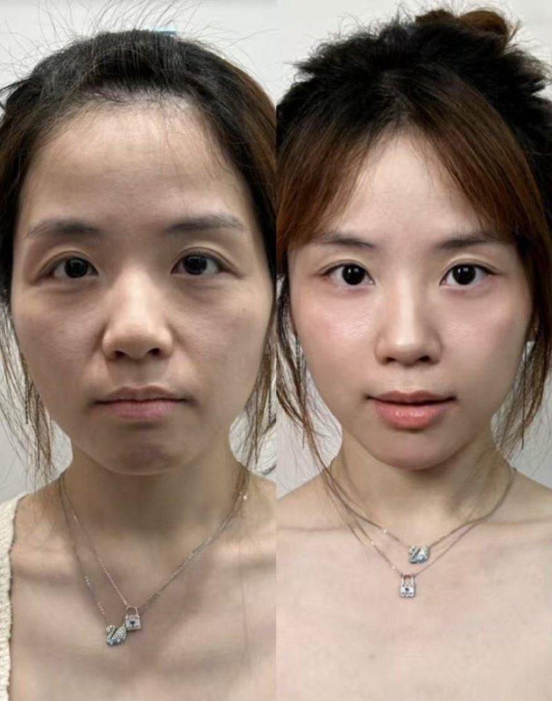 三、光电类除皱项目：从2年到10年，疗程与护理影响关键