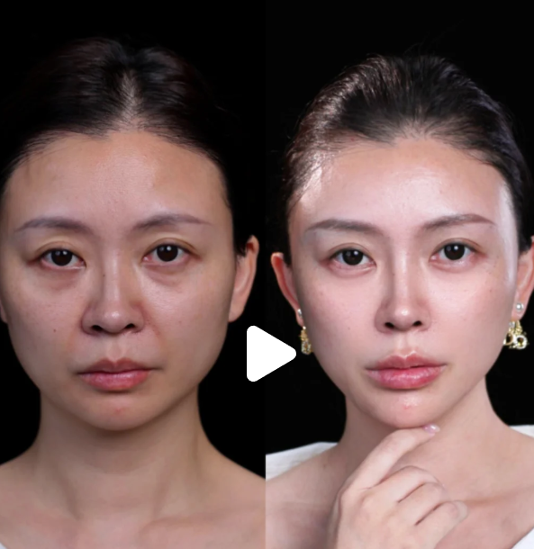 五、割完双眼皮吃芝士的其他注意事项