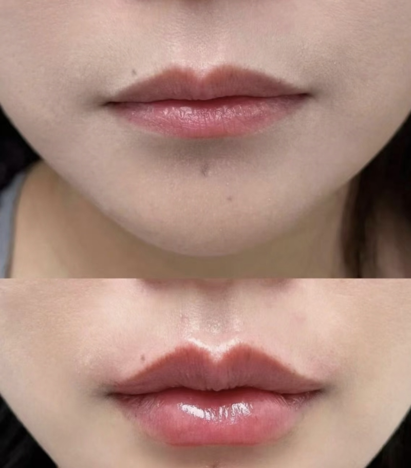 三、双眼皮+开眼角联合手术的四大优势