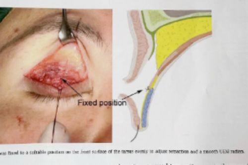 三、影响凹形疤痕治疗费用的核心因素