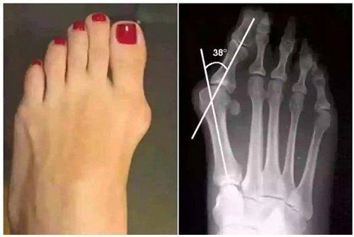 五、从临床实例看疤痕红印的淡化过程