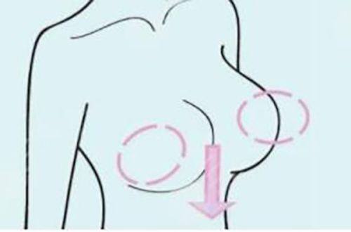 五、结构性眼袋该怎么解决？