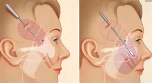 六、临时美学修饰与专精预防建议