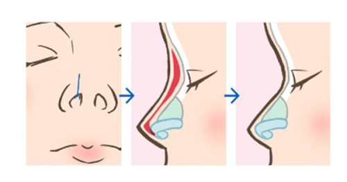 四、增生疤治疗的核心注意事项