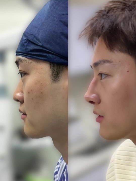 三、眼袋打针淤青的日常行为禁忌，千万别踩雷