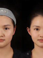 三、术后长期养护(3个月以上,延长成效时效)