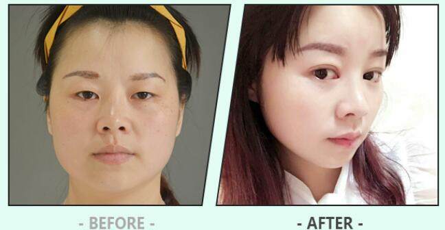 三、全身牛奶酸+光子嫩肤套餐价格参考