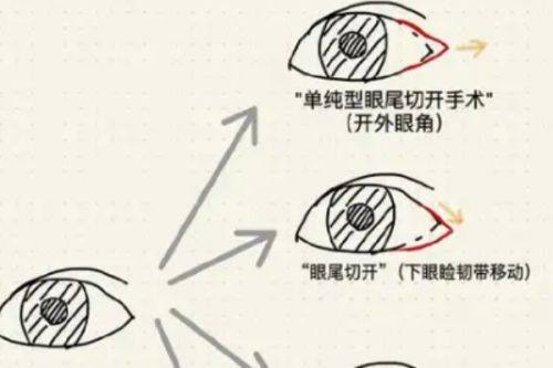 五、胸部抽脂多久可以修复正常生活?分术式看生活回归节奏