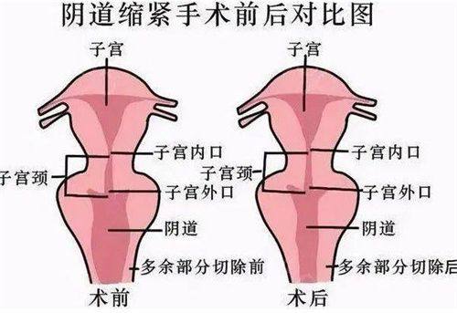 二、不同无痕去眼袋技术的成效特色对比